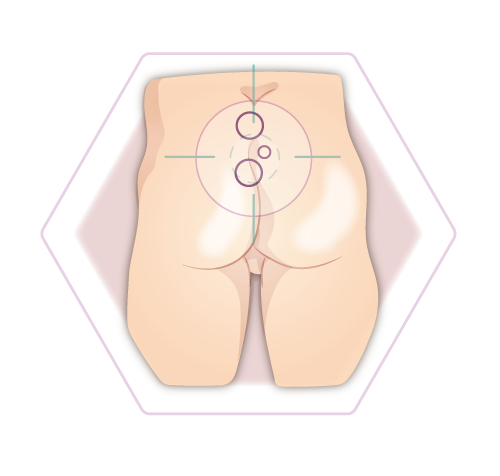 Illustration Steißbeinfistel vorbeugen haarfreiheit Stuttgart