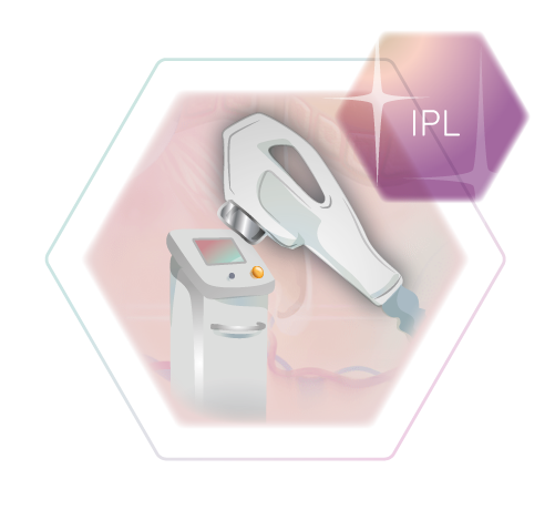 Illustration IPL Haarfreiheit Stuttgart