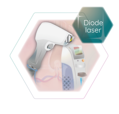 Diode laser technology haarfreiheit stuttgart