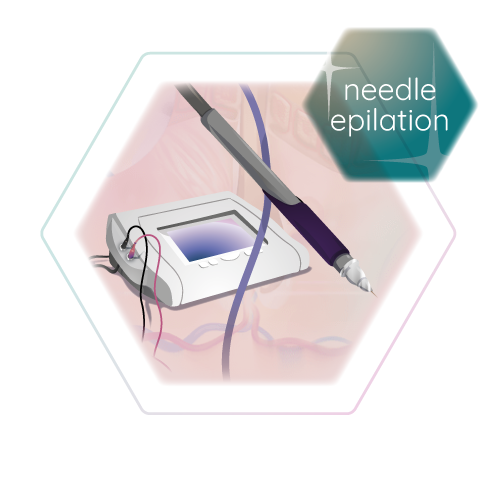 needle epilation technology haarfreiheit stuttgart